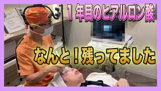 1年前に目の中に入れたヒアルロン酸💉エコーで調べていただきました【美容整形】【眼窩ヒアルロン酸】