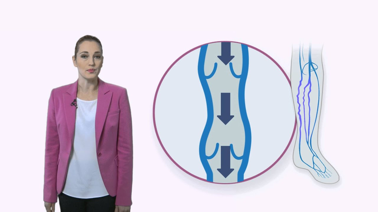 Хроническая венозная недостаточность