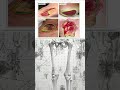 No Labels, Just Prompts: ADZUS is Revolutionizing Medical Imaging