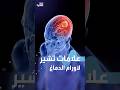 علامات تشير لأورام الدماغ 