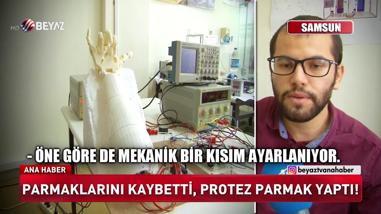 Parmaklarını kaybetti, protez parmak yaptı!
