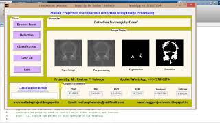 Osterporosis Detection using Image Processing Matlab Project with Source code
