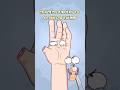 Craziest Surgery to rebuild a thumb?