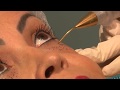 Blefaroplastia sem corte!VÍDEO NOVO//www.youtube.com/watch?v=zH-v7N1Ov7s