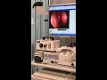 In-Office Balloon Dilation Left Maxillary Sinus-minimal discomfort