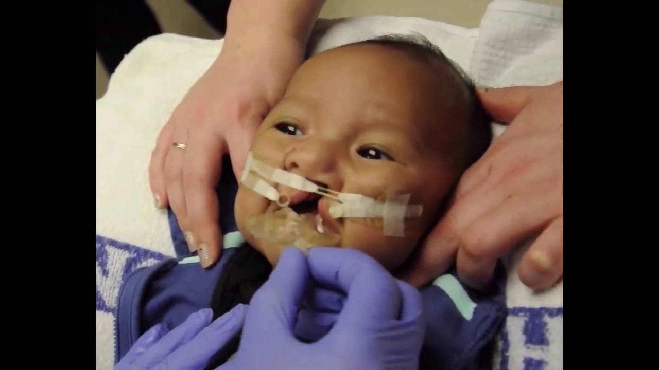 Newborn With Severe Head Molding Shows How Much Babies Go Through During Birth forecasting Newborn With Severe Head Molding Shows How Much Babies Go Through During Birth recommend