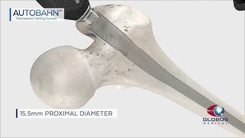AUTOBAHN Trochanteric Nailing System Technique Animation