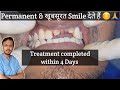 Smile design just in 4 days  fractured teeth smile makeover