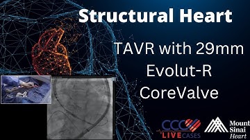 TAVR with 29mm Evolut-R CoreValve - Structural Heart Sept 2017