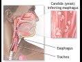 Candida esophagitis