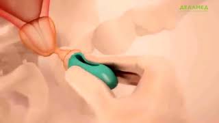 Установка пессария акушерского Dr.Arabin Установка пессария акушерского Dr.Arabin