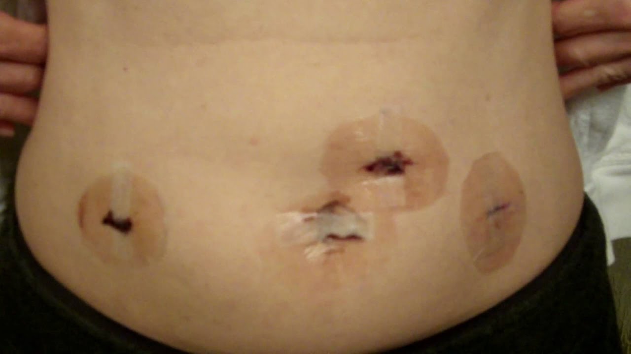 Surgical Wound Infection Symptoms, Diagnosis, Treatments ...
