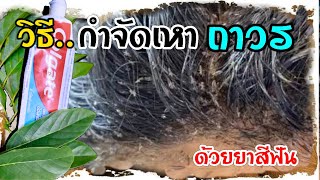 รีบหาทำ!! วิธีกำจัดเหาถาวร ใน 2 นาที เหาและไข่เหาหายเกลี้ยง หายขาด ปลอดสารพิษ 100%