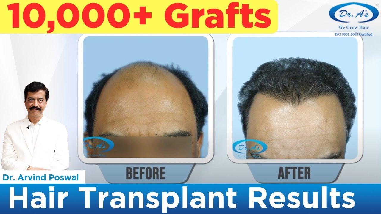 Video Thinning Hair Transplant Results With DrUGraft Beard Hair  Extractions