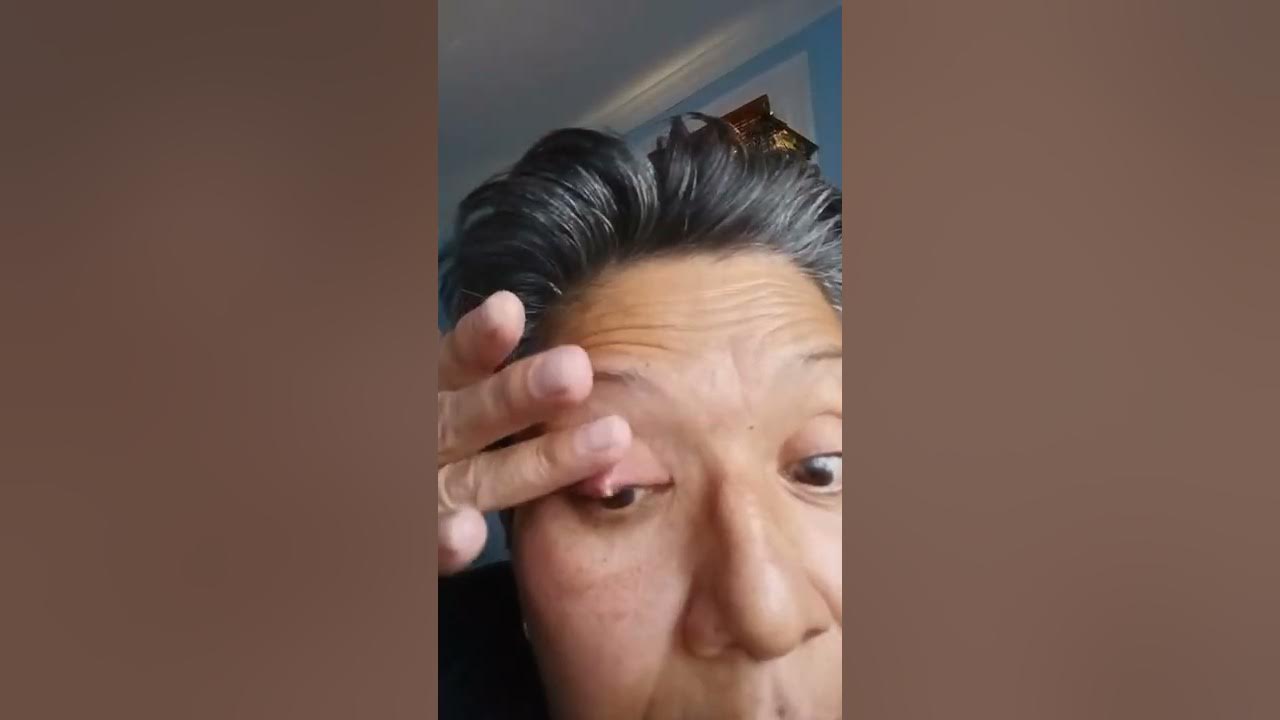 What Happens If You Pop A Gum Cyst