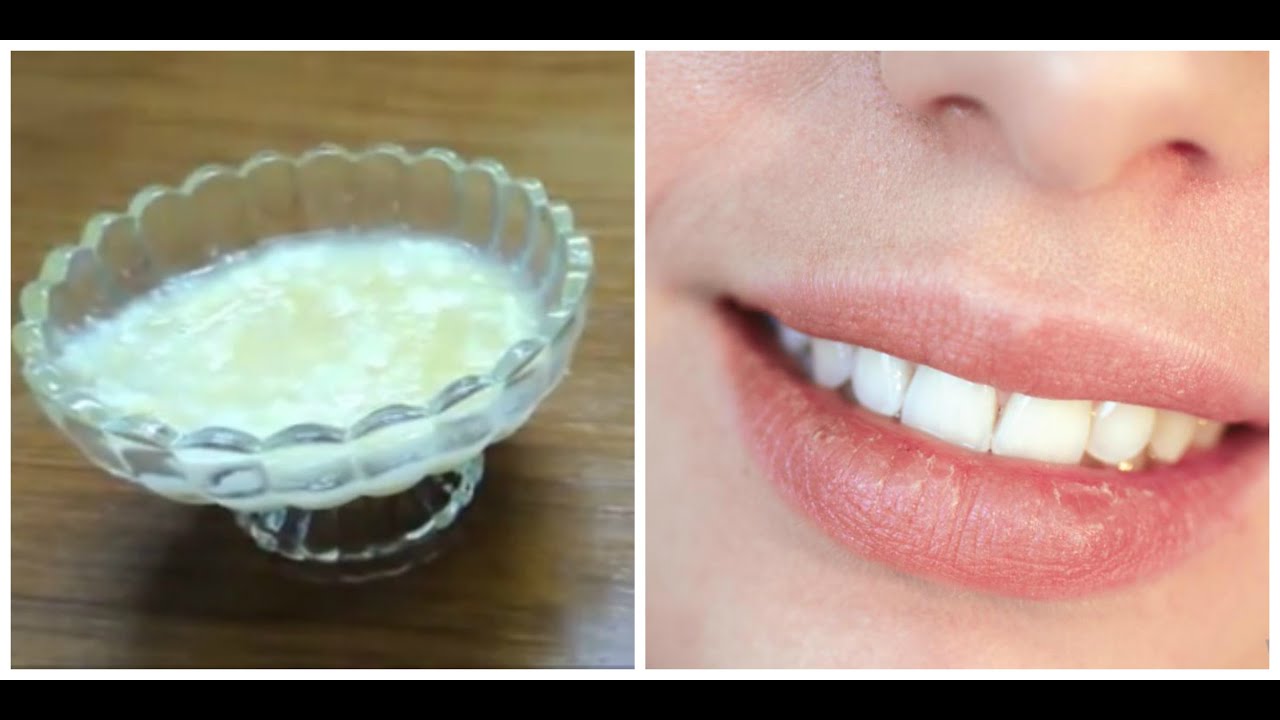 I Have Dark Spots on my Lower Lip? Doctor Answers, Tips