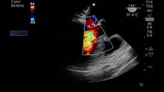 Asvide: Transesophageal echocardiography (TEE) revealed left ventricular outflow tract ...