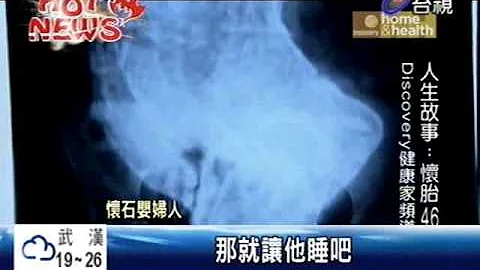 75歲婦懷胎46年腹中取「石嬰」 - 天天要聞