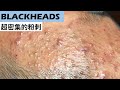 超密集的粉刺(blackheads) part 1 - Taiwan Tainan台南清粉刺最乾淨