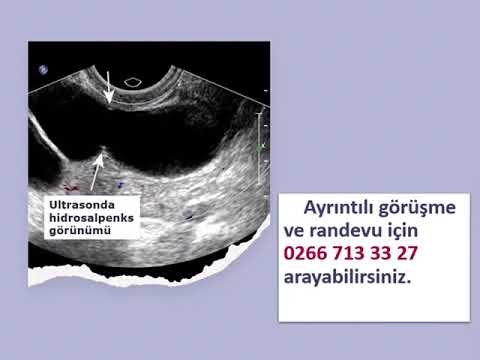 Hidrosalpinks (Hidrosalpenks) Nedir?