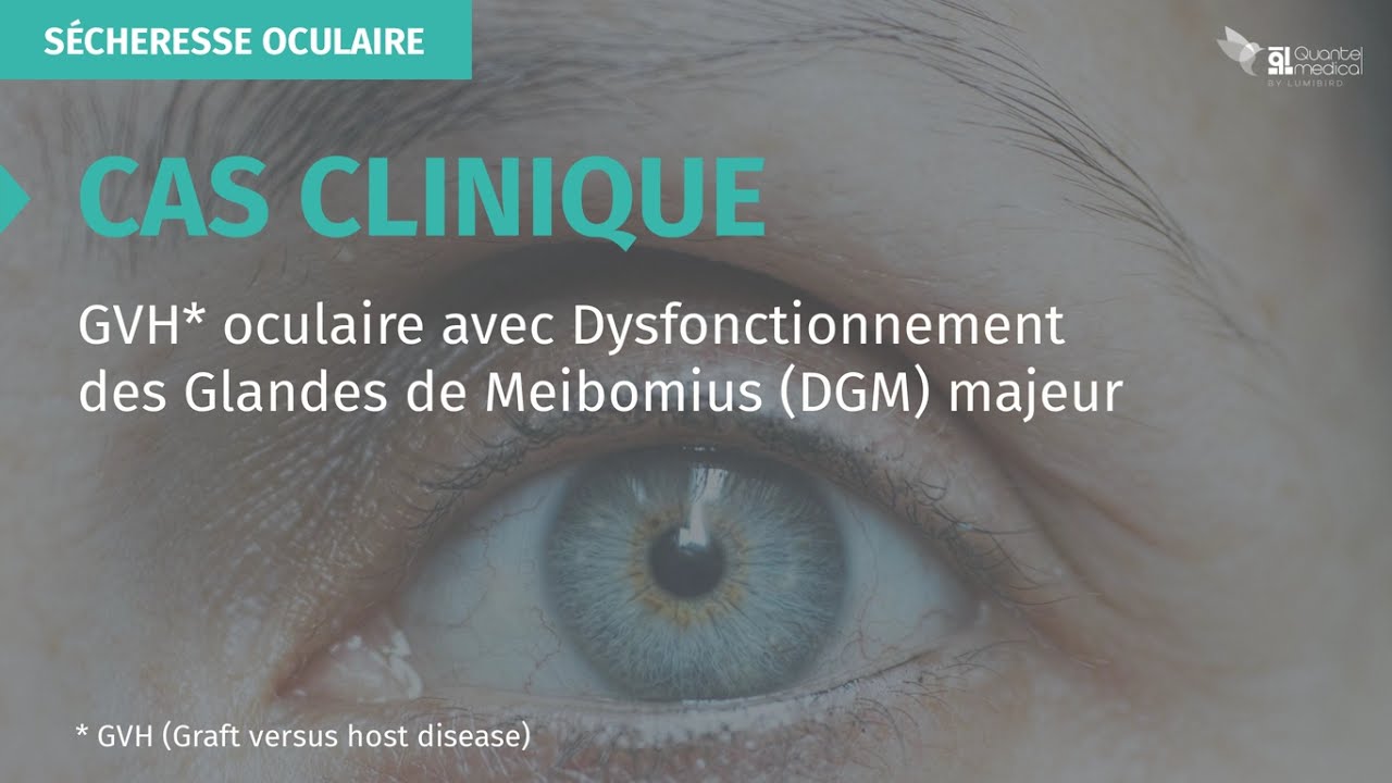 Cas clinique GVH oculaire avec Dysfonctionnement des Glandes de Meibomius (DGM) majeur YouTube Cas clinique GVH oculaire avec Dysfonctionnement des Glandes de Meibomius (DGM) majeur YouTube