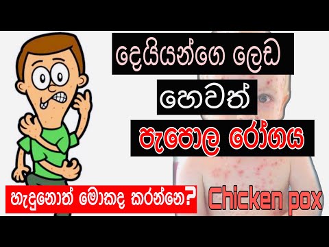 chicken pox (papola) sinhala,symptoms,treatments(clear explanation) | Sinhala medical channel