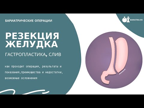 Резекция желудка (гастропластика, слив). Все что нужно знать об операции