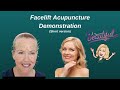 Self acupuncture facelift  an alternative facial rejuvenation procedure
