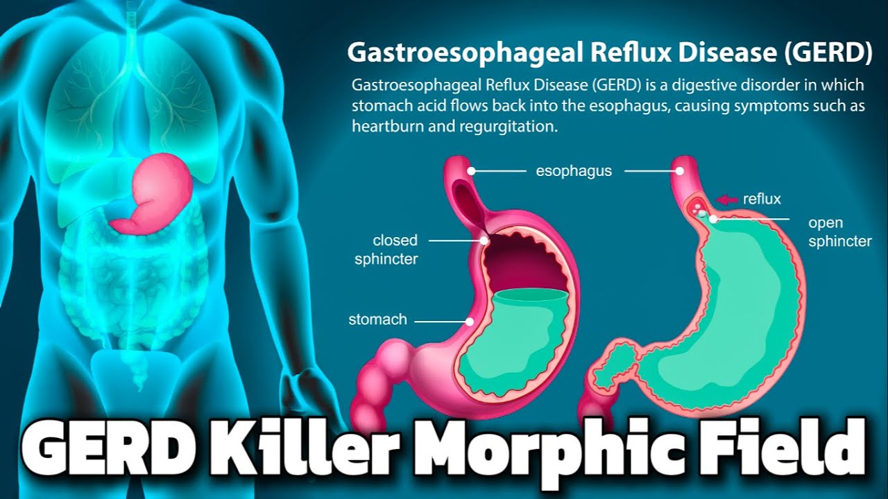 Gastroesophageal Reflux Disease (GERD) Killer Morphic Field - Repair Acid Reflux Damage