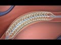 Absorbable Stent