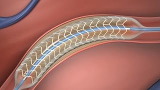 Absorbable Stent