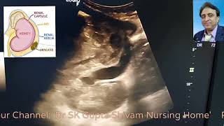 Perinephric Abscess on Ultrasound