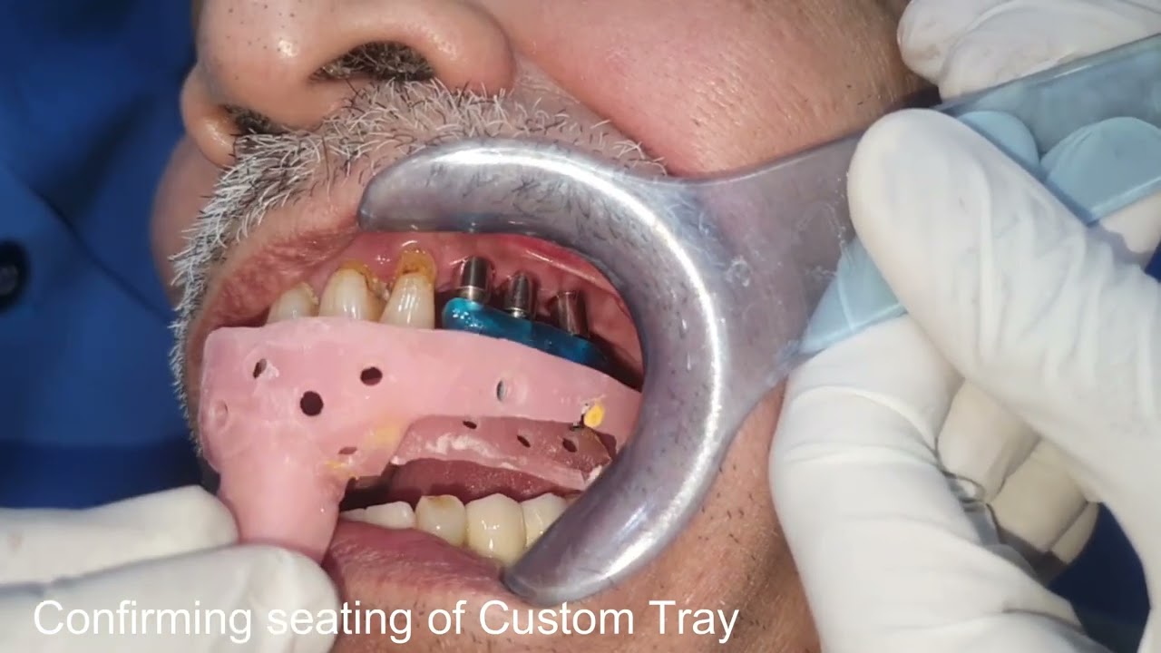 Implant Level Impression Open Tray Technique By Dr  Akash Akinwar, MDS