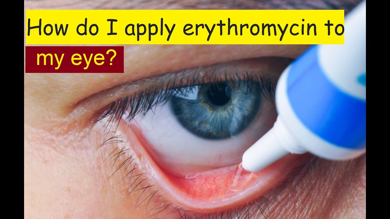 how-do-i-apply-erythromycin-to-my-eye-youtube