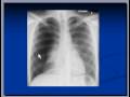 Chest x-ray interpretation, Pneumothorax