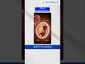 Polyhydramnios High Water Level in Pregnancy Explained by Doctor