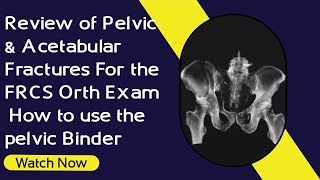 Review of Pelvic & Acetabular Fractures For the FRCS Orth Exam | How to use the pelvic Binder