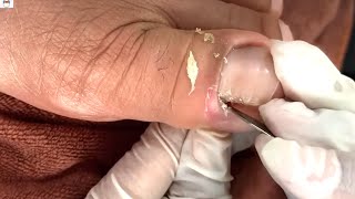 How to Repair Nails easy # 451 - Xuyen Nail