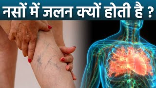 नसों में जलन क्यों होती है | Naso Mein Jalan Kyu Hoti Hai |Boldsky