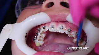 Watch Braces Go On in 1-minute | Team Orthodontics Metal Braces