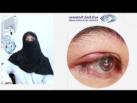 د إيمان بدوي الأكياس الدهنية في جفون العين