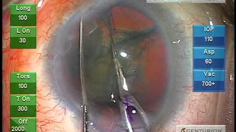 MICS Suite by ASICO with Alcon Centurion™ Grade III Cataract by Dr. Akahoshi