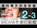 マルチループワイヤー(MEAW)を下の歯に装着｜歯列矯正の全記録2-3