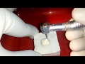 demo class 1 cavity on extracted maxillary molar