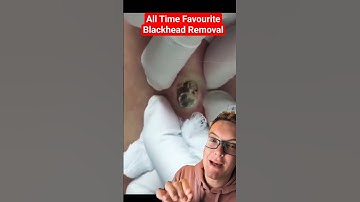 Greatest Ever BLACKHEAD REMOVAL - Nothing Beats This #shorts