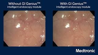 GI Genius Intelligent Endoscopy