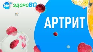 Артрит: Причины Возникновения, Симптомы и Профилактика | ЗдороВо Артрит: Причины Возникновения, Симптомы и Профилактика | ЗдороВо
