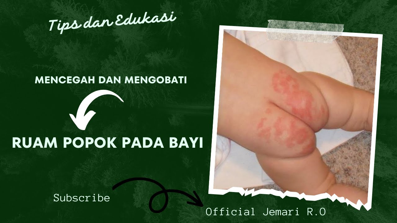 Tips and Education Prevention and Treatment of Diaper Rash in Babies