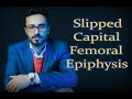 06 Slipped Capital Femoral Epiphysis