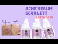 ACNE SERUM SCARLETT REVIEW